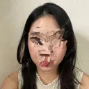 骨削り（頬） ボンディ美容整形外科（旧リオン整形外科） DAY 132 サムネイル用