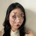 骨削り（頬） ボンディ美容整形外科（旧リオン整形外科） DAY 132 サムネイル用