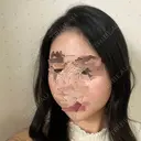 骨削り（頬） ボンディ美容整形外科（旧リオン整形外科） DAY 132 サムネイル用