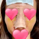 鼻中隔延長（切開） / 骨切幅寄せ / ワシ鼻修正・ハンプ切除 表参道スキンクリニック 表参道院 DAY 5 サムネイル用