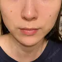ハイフ（顔） Zetith Beauty Clinic 銀座院 AFTER サムネイル用