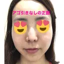 糸リフト / ボトックス（あご） / 肌ヒアルロン酸注入（たるみ・シワ改善） / ボトックス（口角） 湘南美容クリニック 秋葉原院 DAY 28 サムネイル用