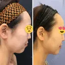 糸リフト / ボトックス（あご） / 肌ヒアルロン酸注入（たるみ・シワ改善） / ボトックス（口角） 湘南美容クリニック 秋葉原院 DAY 28 サムネイル用