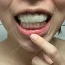 ガミースマイル手術 / 矯正（ワイヤー） / セラミック / ホワイトニング ラ・ブージュデンタルクリニック DAY 1 サムネイル用