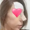 鼻中隔延長（切開） / 骨切幅寄せ / ワシ鼻修正・ハンプ切除 表参道スキンクリニック 表参道院 DAY 7 サムネイル用