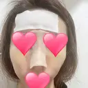 鼻中隔延長（切開） / 骨切幅寄せ / ワシ鼻修正・ハンプ切除 表参道スキンクリニック 表参道院 DAY 7 サムネイル用