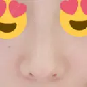 鼻尖形成（切開） / 鼻中隔延長（切開） / 軟骨移植 / 鼻翼基部形成（貴族手術） HANABI整形外科 DAY 17 サムネイル用