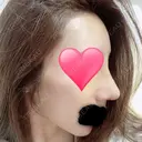 鼻中隔延長（切開） / 骨切幅寄せ / ワシ鼻修正・ハンプ切除 表参道スキンクリニック 表参道院 DAY 7 サムネイル用