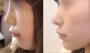 隆鼻術 / 鼻尖形成（切開） / 鼻中隔延長（切開） / 小鼻縮小（切開） / 軟骨移植 HANABI整形外科 DAY 224 サムネイル用