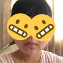 その他（輪郭） 品川美容外科 静岡院 DAY 70 サムネイル用