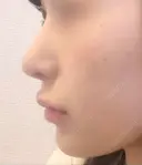 隆鼻術 / 鼻尖形成（切開） / 鼻中隔延長（切開） / 小鼻縮小（切開） / 軟骨移植 HANABI整形外科 DAY 249 サムネイル用