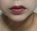 ボトックス（エラ・小顔） / 脂肪溶解注射（顔） / ヒアルロン酸注入（唇） / ボトックス（口角） id美容クリニック 銀座院 AFTER サムネイル用