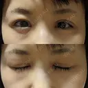 二重切開 / 目頭切開 / 眼瞼下垂（切開） / 目尻切開 湘南美容クリニック 大阪堺東院 DAY 23 サムネイル用