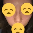 鼻尖縮小 東京ヒルズクリニック 新宿院 AFTER サムネイル用