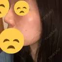 鼻尖縮小 東京ヒルズクリニック 新宿院 DAY 11 サムネイル用