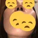 鼻尖縮小 東京ヒルズクリニック 新宿院 DAY 11 サムネイル用