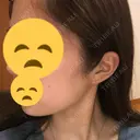 ボトックス（エラ・小顔） 東京ヒルズクリニック 新宿院 DAY 11 サムネイル用