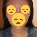 ボトックス（エラ・小顔） 東京ヒルズクリニック 新宿院 DAY 11 サムネイル用