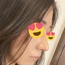 鼻尖形成（切開） / 鼻中隔延長（切開） / 軟骨移植 表参道スキンクリニック 表参道院 AFTER サムネイル用
