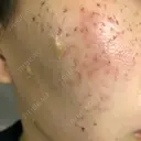 ほくろ・いぼ切除（肌） / 美肌レーザー / シミ取りレーザー / 美白レーザー REYOUNGクリニック DAY 0 サムネイル用