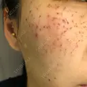 ほくろ・いぼ切除（肌） / 美肌レーザー / シミ取りレーザー / 美白レーザー REYOUNGクリニック DAY 1 サムネイル用