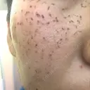 ほくろ・いぼ切除（肌） / 美肌レーザー / シミ取りレーザー / 美白レーザー REYOUNGクリニック DAY 3 サムネイル用