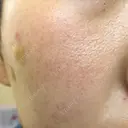 ほくろ・いぼ切除（肌） / 美肌レーザー / シミ取りレーザー / 美白レーザー REYOUNGクリニック DAY 4 サムネイル用