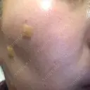 ほくろ・いぼ切除（肌） / 美肌レーザー / シミ取りレーザー / 美白レーザー REYOUNGクリニック AFTER サムネイル用