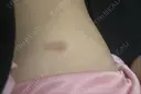 隆鼻術 / 鼻尖形成（切開） / 鼻中隔延長（切開） / 小鼻縮小（切開） / 軟骨移植 HANABI整形外科 DAY 248 サムネイル用