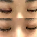 二重埋没 湘南美容クリニック 宇都宮院 DAY 2 サムネイル用