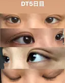 二重埋没 TCB東京中央美容外科 仙台駅前院 DAY 7 サムネイル用