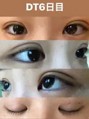 二重埋没 TCB東京中央美容外科 仙台駅前院 DAY 7 サムネイル用