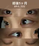 二重埋没 TCB東京中央美容外科 仙台駅前院 DAY 33 サムネイル用