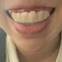 ガミースマイル手術 / 矯正（ワイヤー） / セラミック / ホワイトニング ラ・ブージュデンタルクリニック DAY 9 サムネイル用