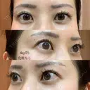 眉下切開 湘南美容クリニック 秋葉原院 DAY 45 サムネイル用