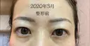 眉下切開 湘南美容クリニック 秋葉原院 DAY 45 サムネイル用