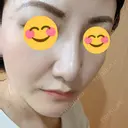 隆鼻術 / 鼻尖形成（切開） / 小鼻縮小（切開） / 軟骨移植 湘南美容クリニック 那覇院 DAY 30 サムネイル用