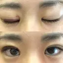 二重埋没 湘南美容クリニック 宇都宮院 AFTER サムネイル用