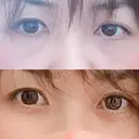クマ治療 / 下まぶたたるみ取り / 下まぶたの脂肪取り TCB東京中央美容外科 中野院 AFTER サムネイル用