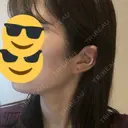 ボトックス（エラ・小顔） 東京ヒルズクリニック 新宿院 DAY 20 サムネイル用