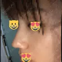 小鼻縮小（切開） / スレッドノーズ / ヒアルロン酸注入（鼻） キップン整形外科 DAY 0 サムネイル用