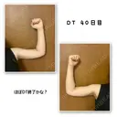 脂肪吸引（二の腕） Mods Clinic（モッズクリニック） 東京院 DAY 40 サムネイル用