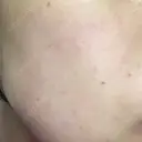 ピーリング（ニキビ・毛穴） 自由が丘クリニック DAY 1 サムネイル用