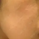 ピーリング（ニキビ・毛穴） 自由が丘クリニック DAY 3 サムネイル用