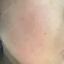 ピーリング（ニキビ・毛穴） 自由が丘クリニック DAY 6 サムネイル用