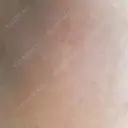 ピーリング（ニキビ・毛穴） 自由が丘クリニック DAY 6 サムネイル用