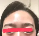 ボトックス（エラ・小顔） / 脂肪溶解注射（顔） / ヒアルロン酸注入（唇） / ボトックス（口角） id美容クリニック 銀座院 DAY 0 サムネイル用