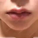 ボトックス（エラ・小顔） / 脂肪溶解注射（顔） / ヒアルロン酸注入（唇） / ボトックス（口角） id美容クリニック 銀座院 DAY 0 サムネイル用