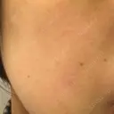 ピーリング（ニキビ・毛穴） 自由が丘クリニック DAY 27 サムネイル用