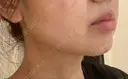 ボトックス（あご） TCB東京中央美容外科 中野院 DAY 28 サムネイル用